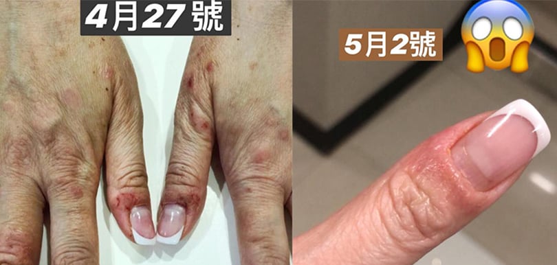劉小慧用蛋黃油醫濕疹！ 中醫教路：製成膏狀可放半年