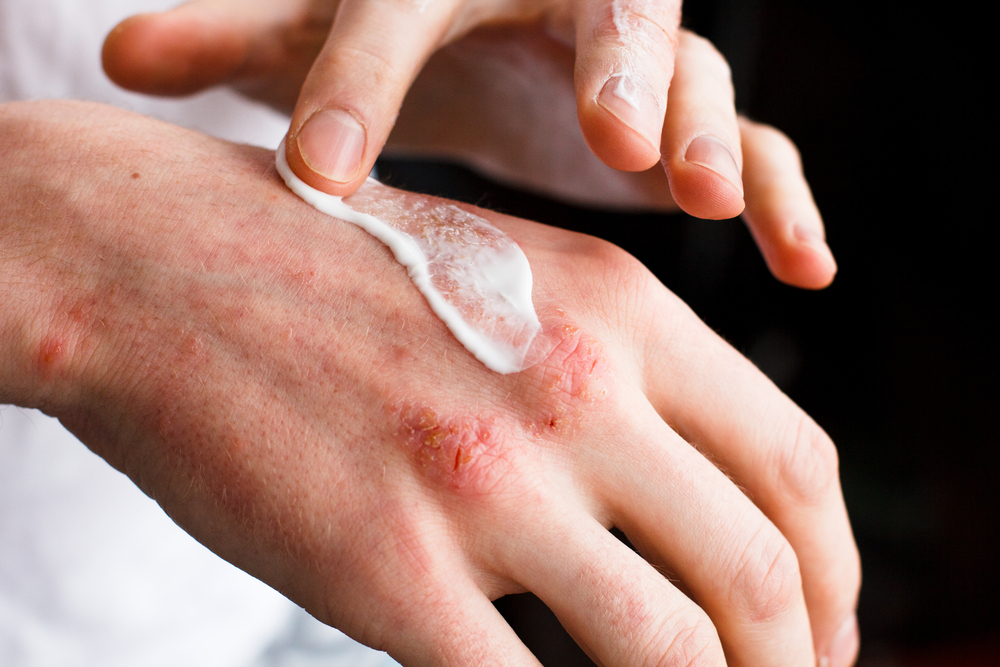 濕疹是轉季常出現的皮膚問題輕微的外塗乳霜
