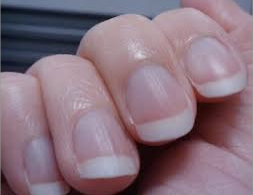 指甲直紋代表什麼