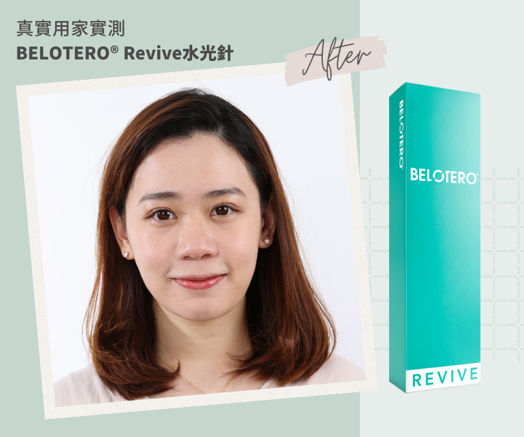 真實用家實測  | BELOTERO®️ Revive水光針深入肌底 全面膚質健康的秘密  水潤少女肌輕鬆get！