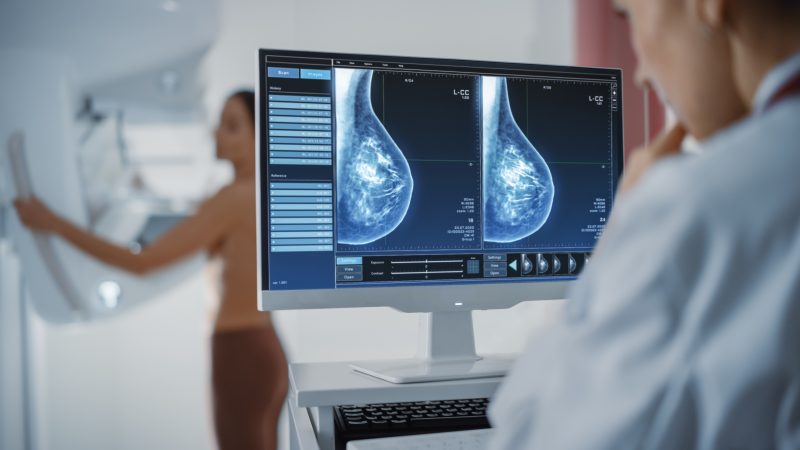 什麼是乳房X光造影（mammography）