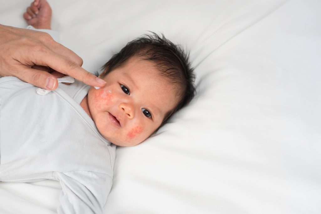 兒童濕疹：中醫籲治療要趁早 免影響睡眠、學習與儀容｜中醫潘子剛