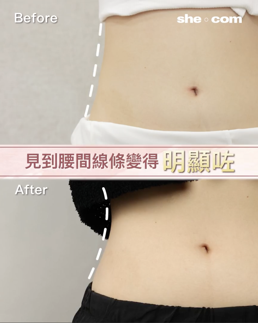 冷凍溶脂-perface-局部瘦身-減肥-coolsculpting