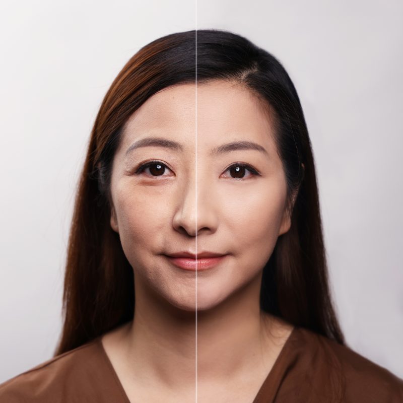 （左）使用前肌膚問題︰眼紋、法令紋、皮膚鬆弛。（右）使用一個月後，臉頰輪廓提升了，法令紋和乾紋略為減淡，肌膚富亮澤感。