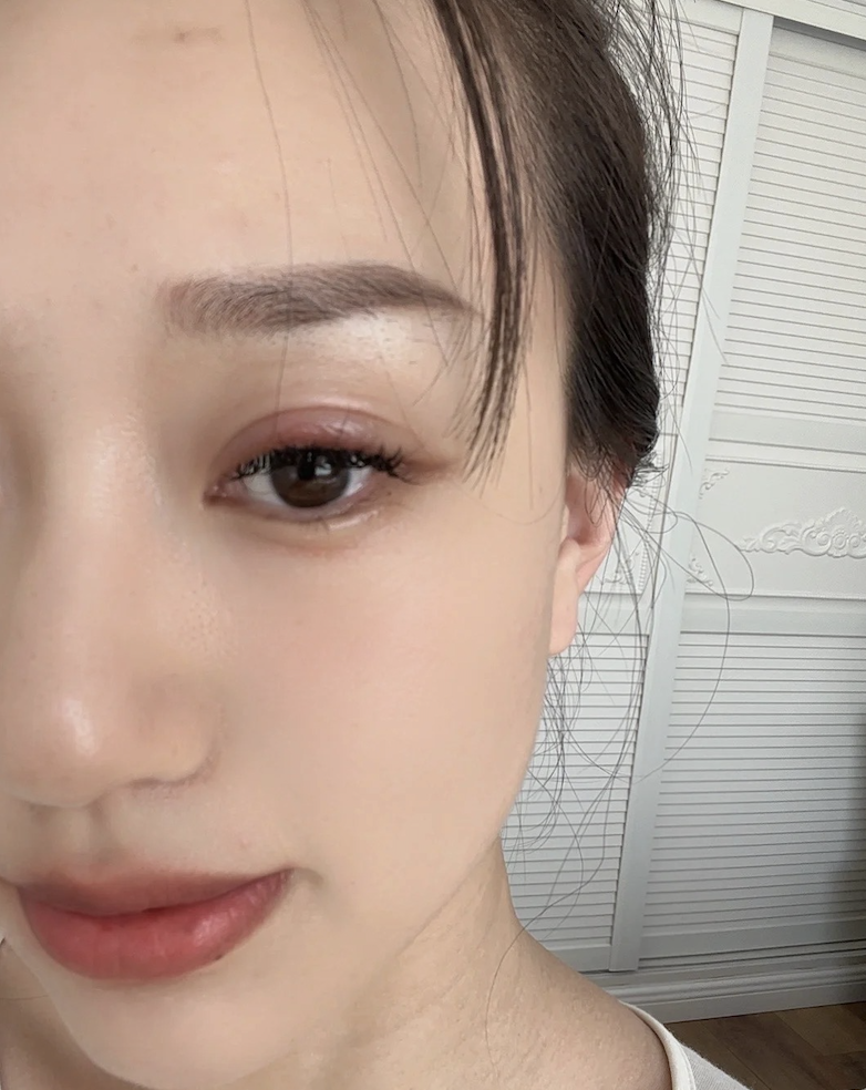 眼挑針 眼瘡 麥粒腫 安俞真 IVE