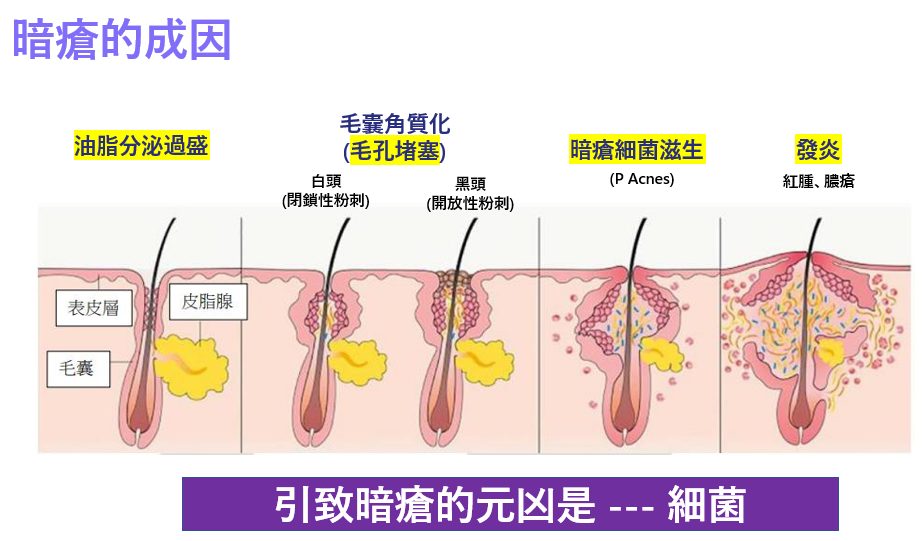 benzac-夏日-暗瘡護理-潔面-抗痘-保濕