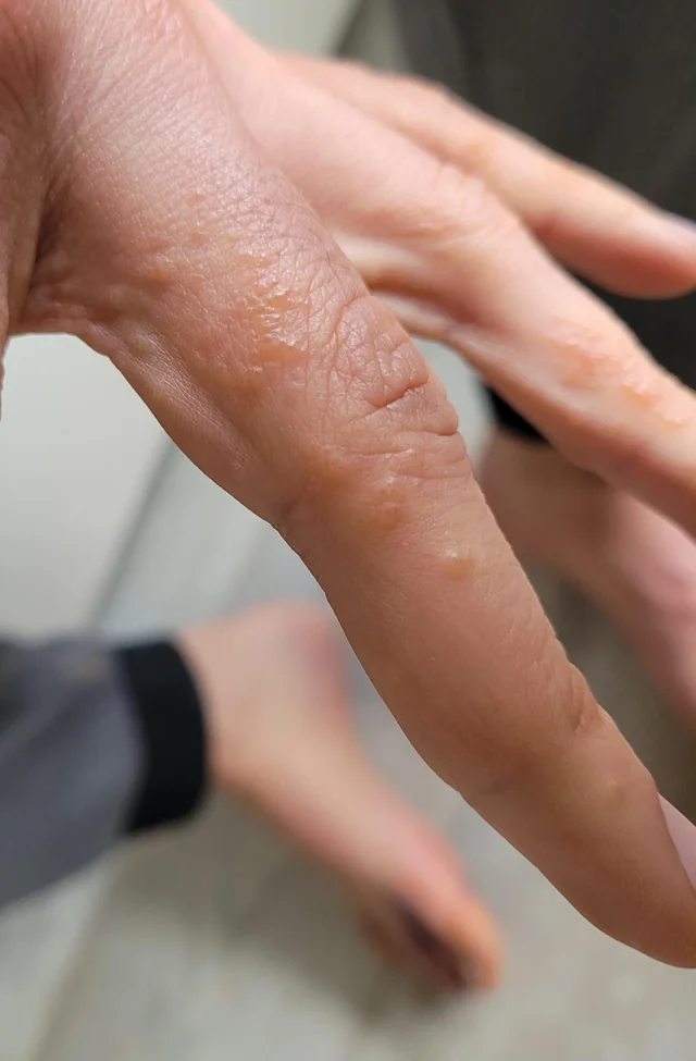 汗皰疹 濕疹 止癢