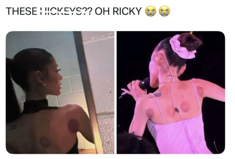拔罐-療法-禁忌-ariana-grande