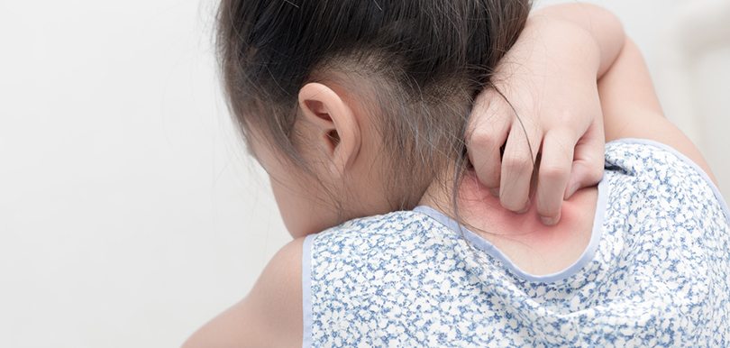 濕疹戒錯口   影響幼兒發育損健康