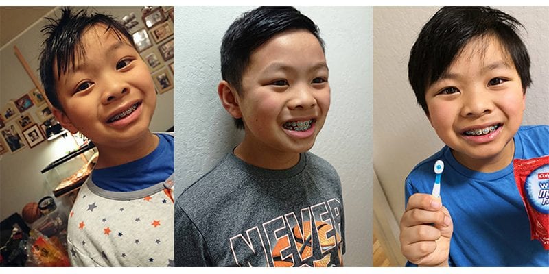 呔媽專欄#230｜點解要10歲仔仔咁早箍牙？
