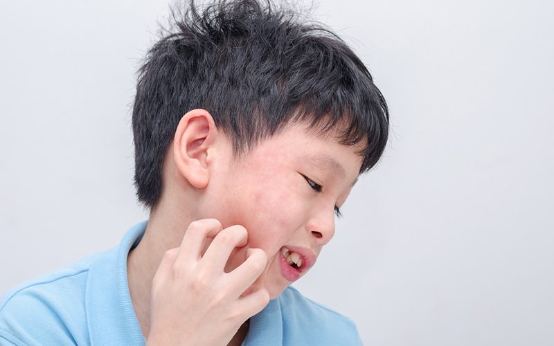 媽媽護士長專欄謎一般的隱形過敏症