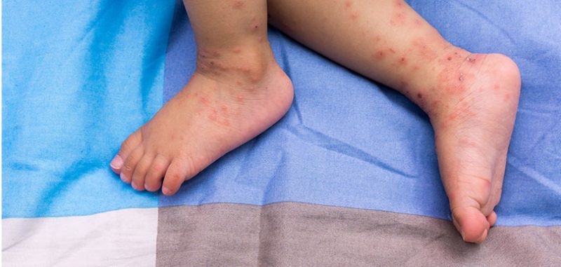 媽媽護士長專欄#41：不能掉以輕心的麻疹