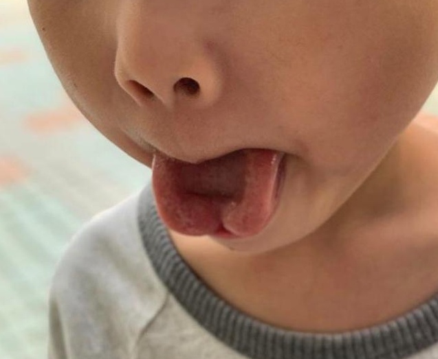 小兒外科顧問：BB吸啜母乳出現困難，可能是因為「黐脷筋」？