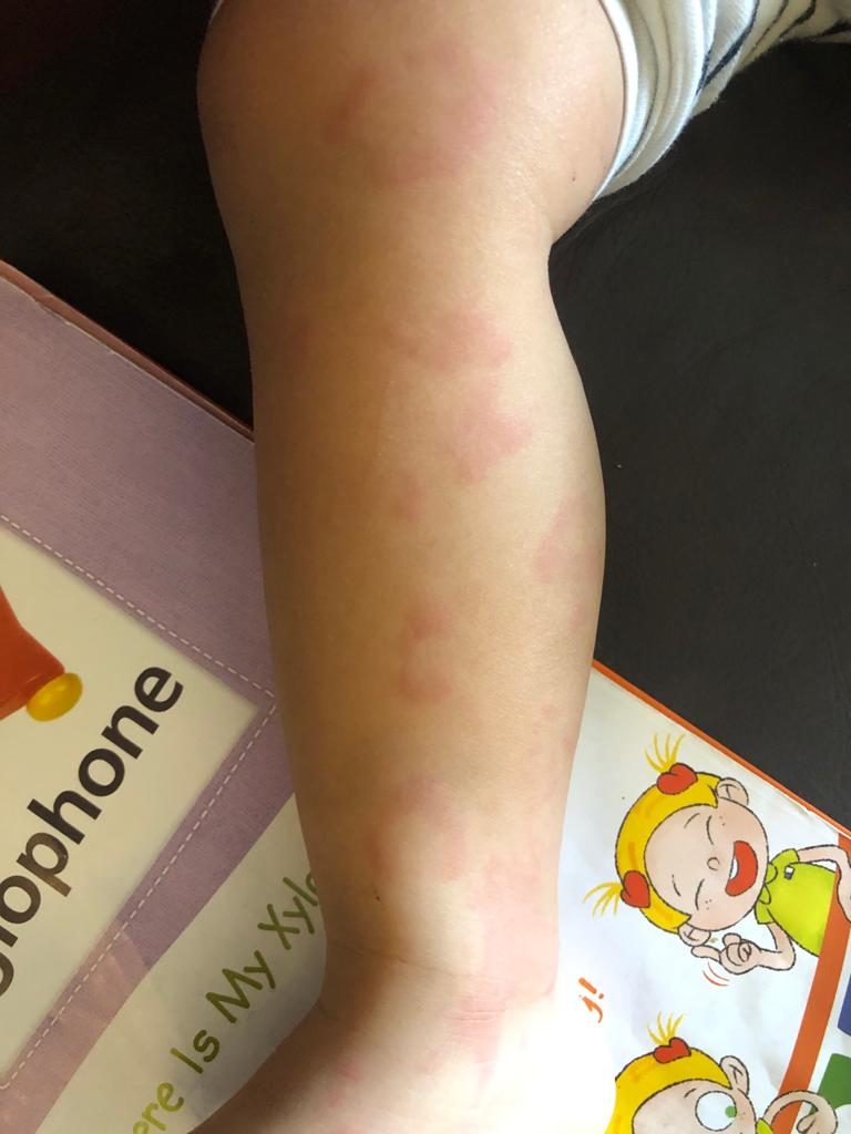 風癩突然出現點算好？前兒童專科護士教你3招輕鬆應對風癩