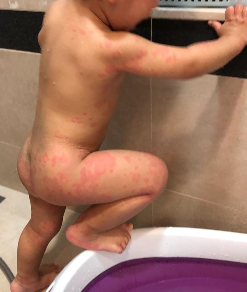 風癩突然出現點算好？前兒童專科護士教你3招輕鬆應對風癩