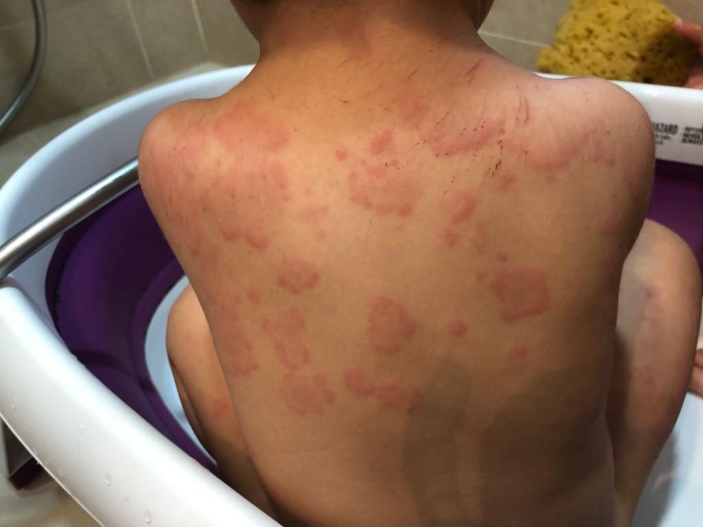 風癩突然出現點算好？前兒童專科護士教你3招輕鬆應對風癩