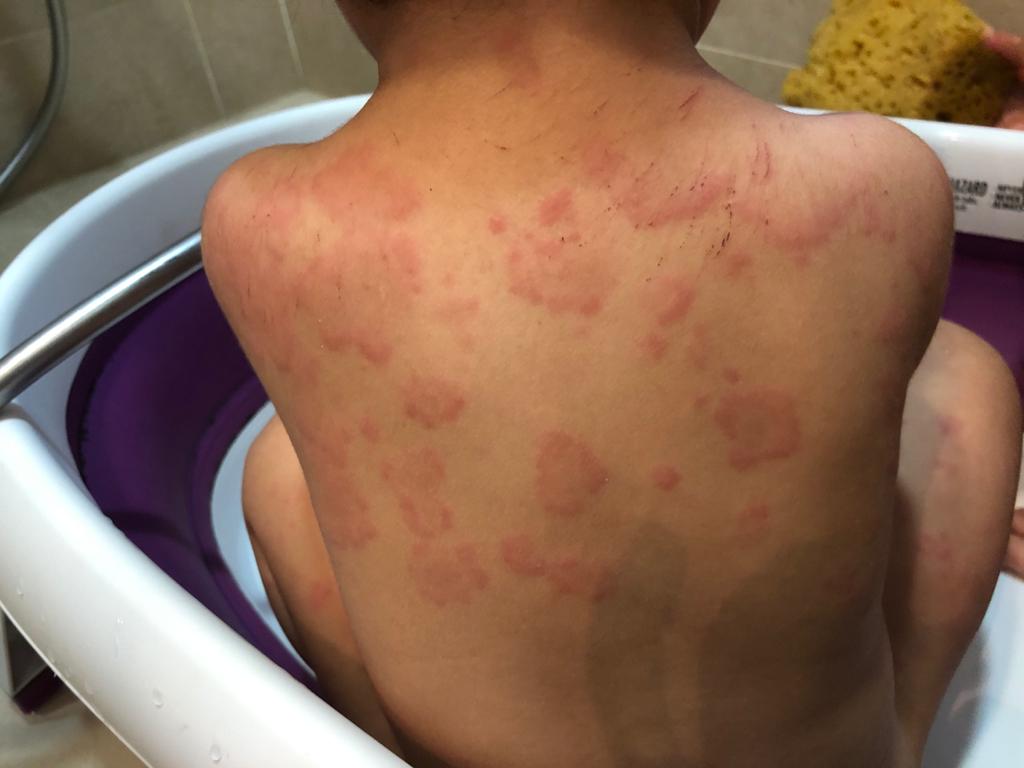 小兒生風癩，點算好？前兒童專科護士教你3招輕鬆應對風癩