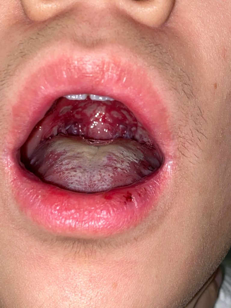 兒童屙嘔肚痛不一定是腸胃炎？嚴重或會導致營養不良｜周中武兒科醫生