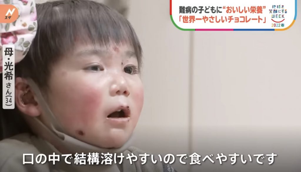 窩心故事｜小朋友患表皮分解性水皰症吞食物都痛！仁醫研製入口即溶營養朱古力表達愛與關懷
