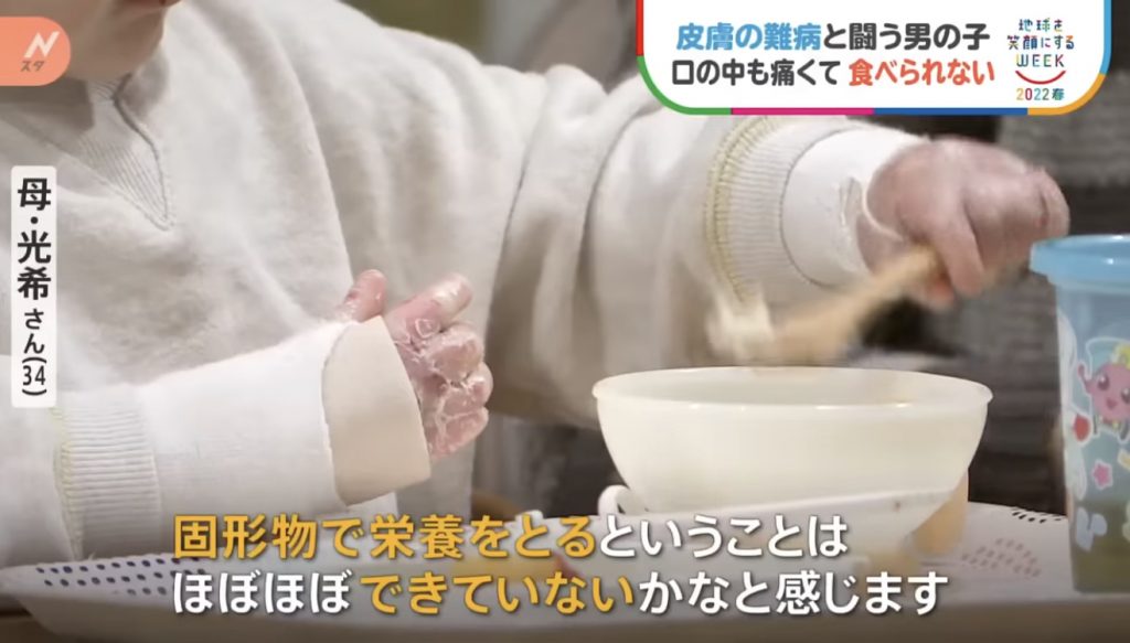 窩心故事｜小朋友患表皮分解性水皰症吞食物都痛！仁醫研製入口即溶營養朱古力表達愛與關懷