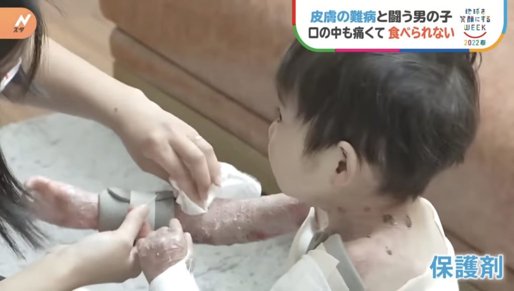窩心故事｜小朋友患表皮分解性水皰症吞食物都痛！仁醫研製入口即溶營養朱古力表達愛與關懷