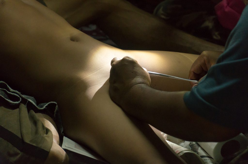 男童包皮過長點處理？如何決定是否要做手術？｜外科專科醫生劉湛益