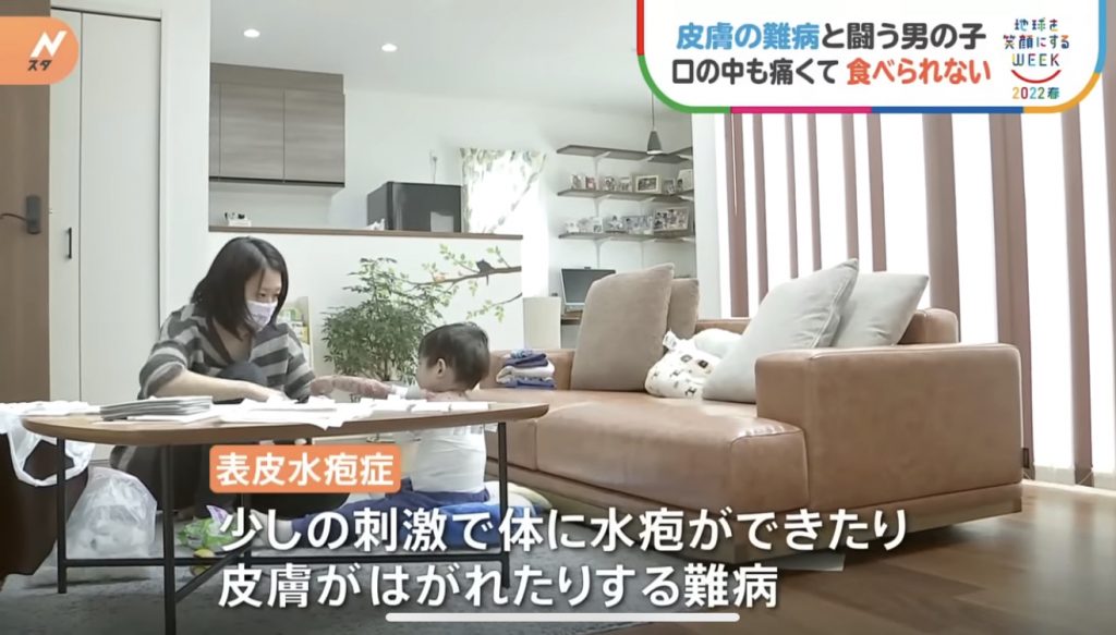 窩心故事｜小朋友患表皮分解性水皰症吞食物都痛！仁醫研製入口即溶營養朱古力表達愛與關懷