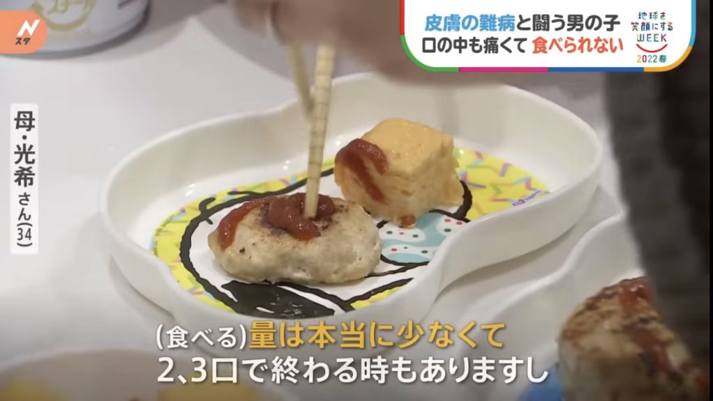 窩心故事｜小朋友患表皮分解性水皰症吞食物都痛！仁醫研製入口即溶營養朱古力表達愛與關懷