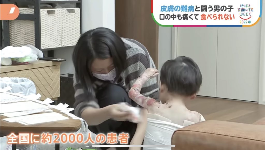 窩心故事｜小朋友患表皮分解性水皰症吞食物都痛！仁醫研製入口即溶營養朱古力表達愛與關懷