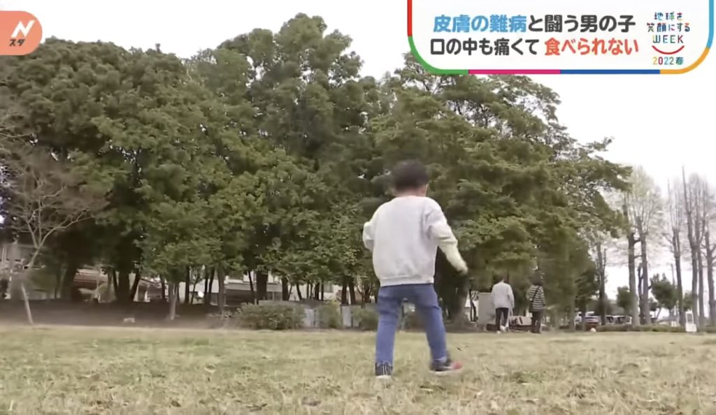 窩心故事｜小朋友患表皮分解性水皰症吞食物都痛！仁醫研製入口即溶營養朱古力表達愛與關懷