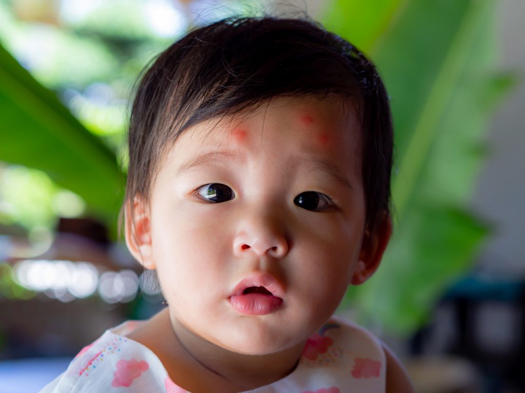 床蝨 嬰幼兒