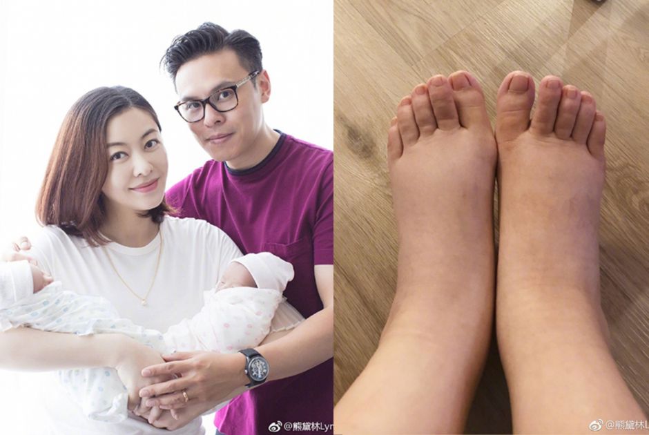 懷孕水腫 水腫 懷孕