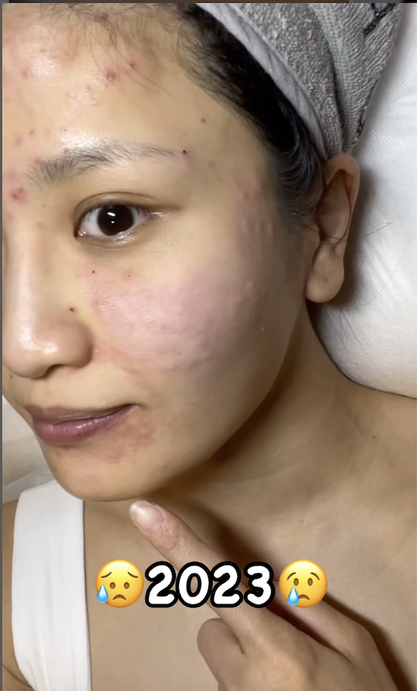 Coffee 林芊妤 暗瘡 中醫 備孕
