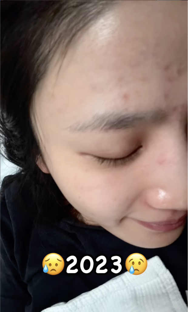 Coffee 林芊妤 暗瘡 中醫 備孕