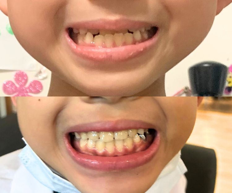 牙齒矯正後對小朋友身心均有正面影響。