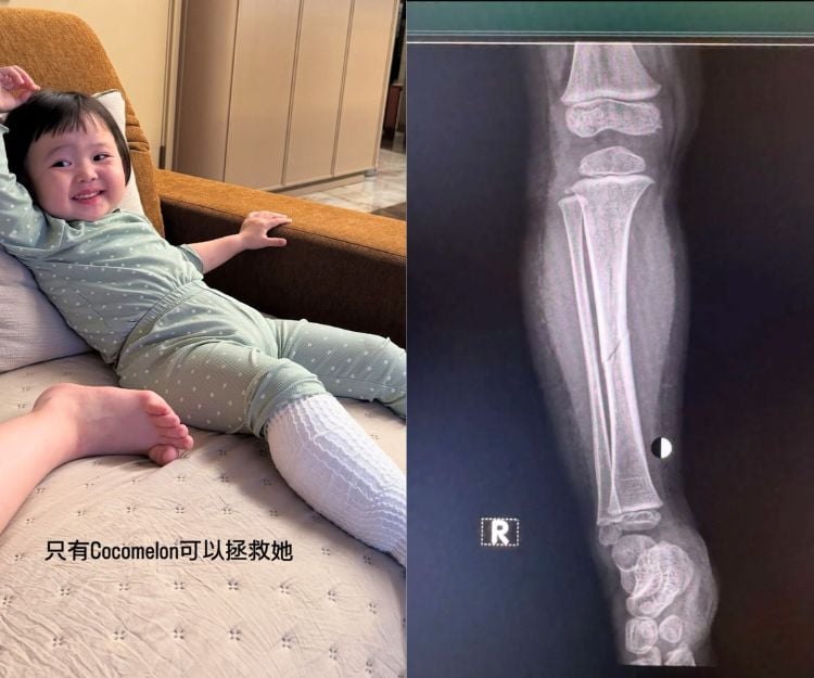 李璨琛2歲女Sucy右腳離奇嚴重骨裂 媽媽心痛：隻腳差少少就斷！骨裂=骨折？小朋友骨折3大徵兆＋處理方法