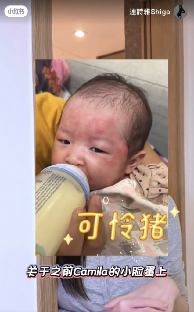 BB紅疹 Shiga 連詩雅