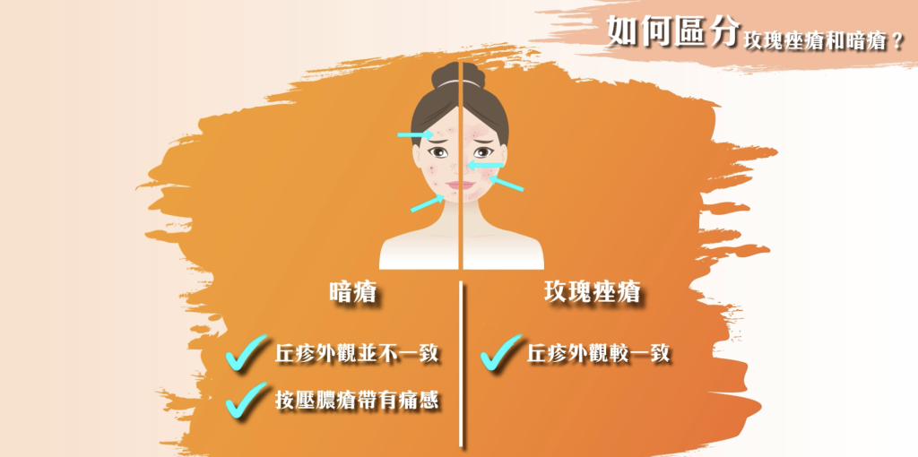 皮膚-玫瑰痤瘡-發炎-毛囊蟎蟲
