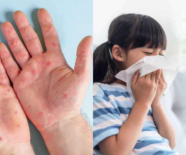 手足口病又爆發？原因、症狀全攻略！家長必收藏4個預防tips